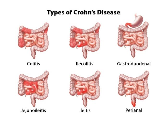 Types of Crohn’s