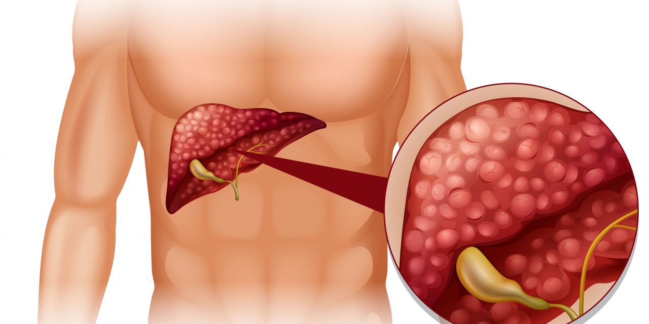 Metabolic Associated Fatty Liver Disease (MAFLD)